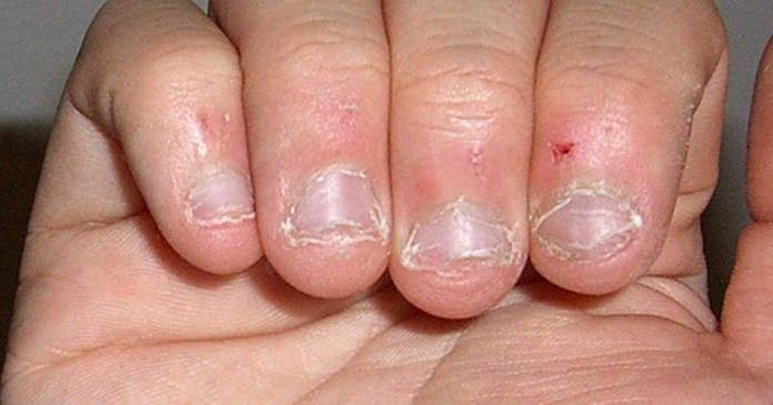 11 ужасающих фактов, которые навсегда заставят вас перестать грызть ногти 