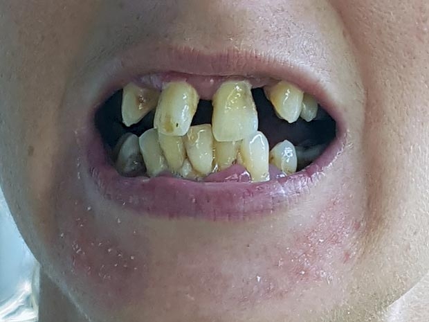 Этой женщине удалили 20 зубов, чтобы избавить её от чудовищно кривых зубов 