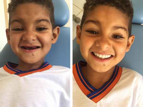 Стоматолог подарила беззубому мальчику новую улыбку 