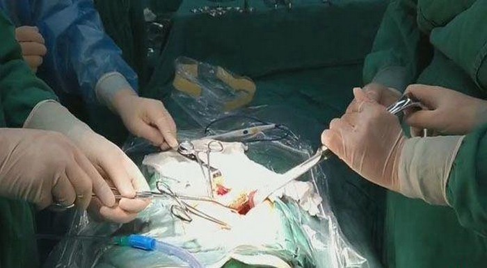 Хирурги вытащили из кишечника китайца 30-сантиметрового угря