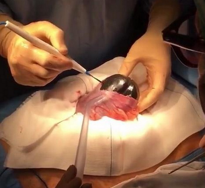 Французские хирурги удаляют инородное тело