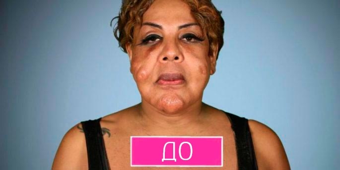 Женщина до и после того, как из её лица был извлечен цемент, введённый во время пластической операции 
