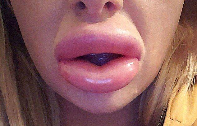 После косметической процедуры губы бабенки превратились в сосиски 