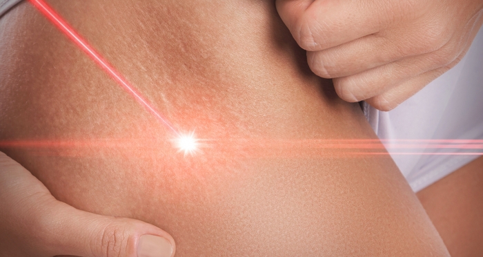 Насколько эффективна лазерная шлифовка растяжек?